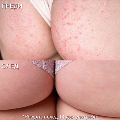 Renova Боди Крем за Пъпки